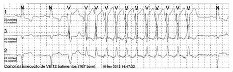 Example Of Nonsustained Ventricular Tachycardia Nsvt On A Holter