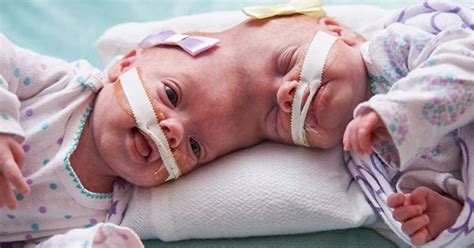 Journey With Conjoined Twins Abby And Erin Delaney A Year In The Life