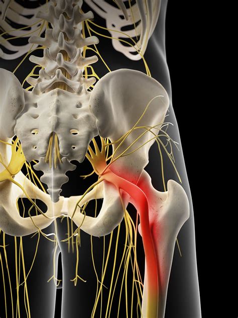 Sciatic Nerve Hip Pain Location Images And Photos Finder