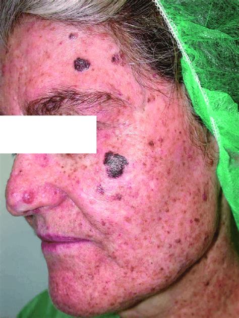 Lentigo Maligna Melanoma On The Cheek And Several Non Melanoma Skin