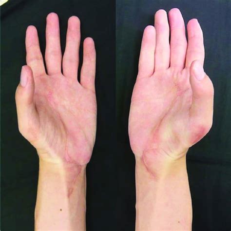 Postoperative Appearance Of The Thumb Palmar Abduction In Both Hands At