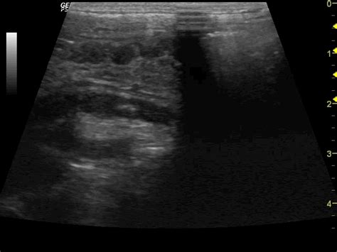 Acute Appendicitis On Ultrasound Image