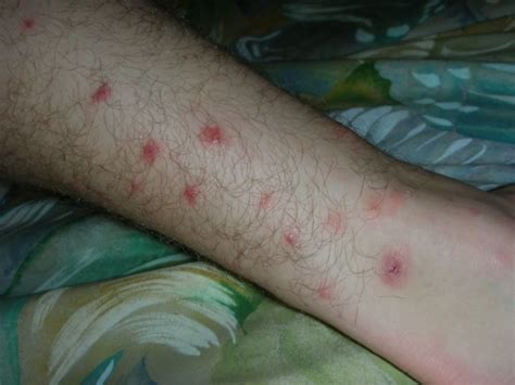 Are There Chiggers In Florida Y L P C