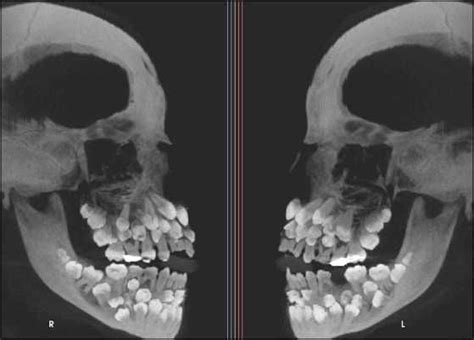 An X Ray Of Someone Who Has Multiple Hyperdontia Hyperdontia Dental