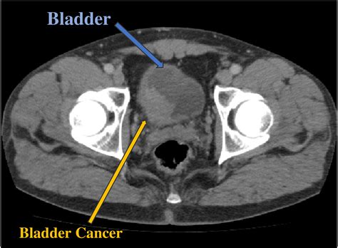 Will Bladder Cancer Show Up On An Ultrasound Updated