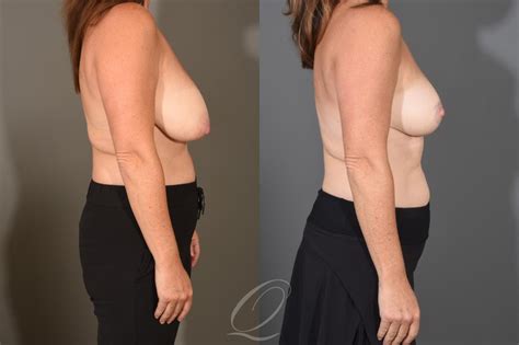 Breast Reduction Before After Photos Patient 1488 Serving Rochester