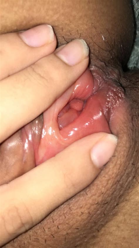 Help Please Flesh Bumps In Vagina Vulval Problems Forums Patient