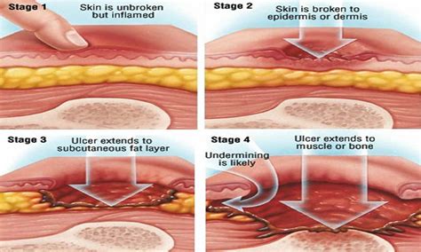 What Are The Five Stages Of Wound Healing Best Home Design Ideas