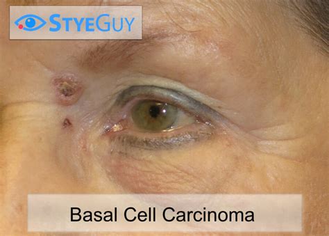 Basal Cell Carcinoma StyeGuy