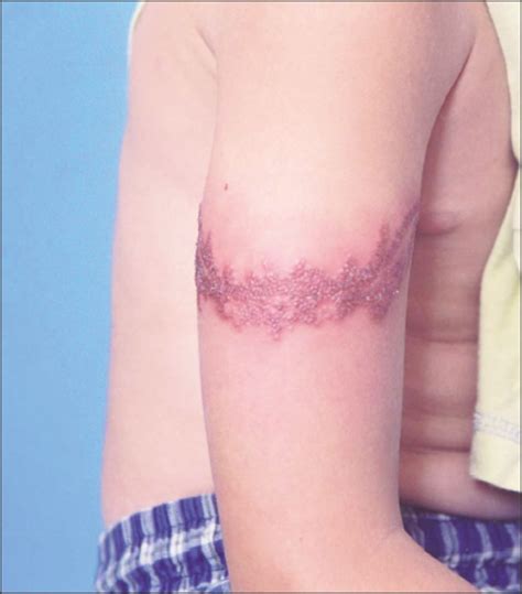 19 Eczema And Tattoos SorayaEverett