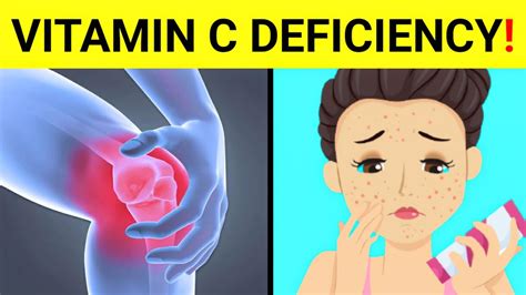 15 Signs And Symptoms Of Vitamin C Deficiency Vitamin C Deficiency