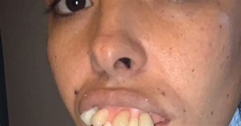 Womans Teeth Transformation Gets Millions Of Views But Some Spot A
