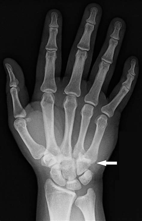 Multiple Carpometacarpal Dislocations The Western Journal Of