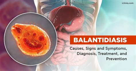 What Is Balantidiasis