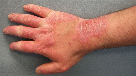 Hand Rashes Causes Tips Prevention And Treatment