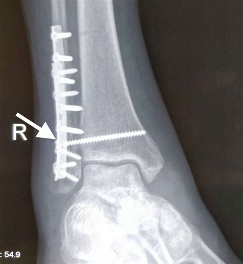 Cureus Osteoporotic Distal Fibula Fractures In The Elderly How To