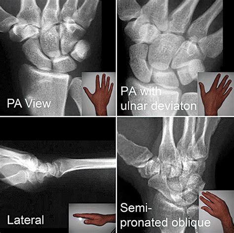 Standard Recommended Scaphoid X Ray Views Postero Anterior Pa Pa