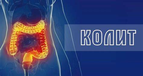 Колит признаки диета Колит - симптомы, причины, лечение, диагностика, диета Колит - симптомы, причины, лечение, диагностика, диета Колит признаки диета