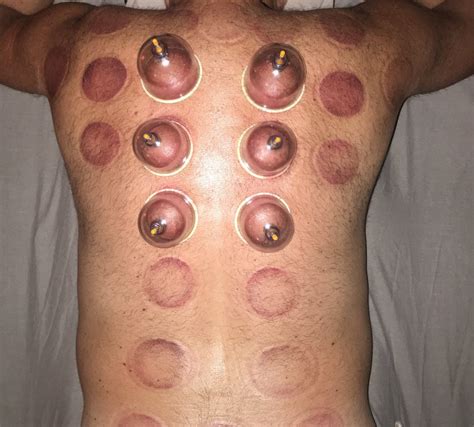 Cupping Your Cold Away Marias Professional Massage