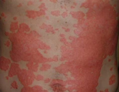 Psoriasis Images Causes Symptoms Treatment Hubpages