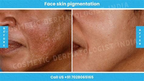 Face Skin Pigmentation Treatment Mumbai Face Pigmentation Skin