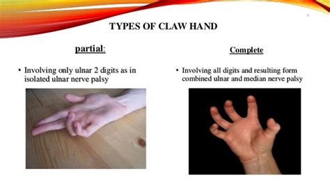 Claw Handcausestypessymptomsmanagement