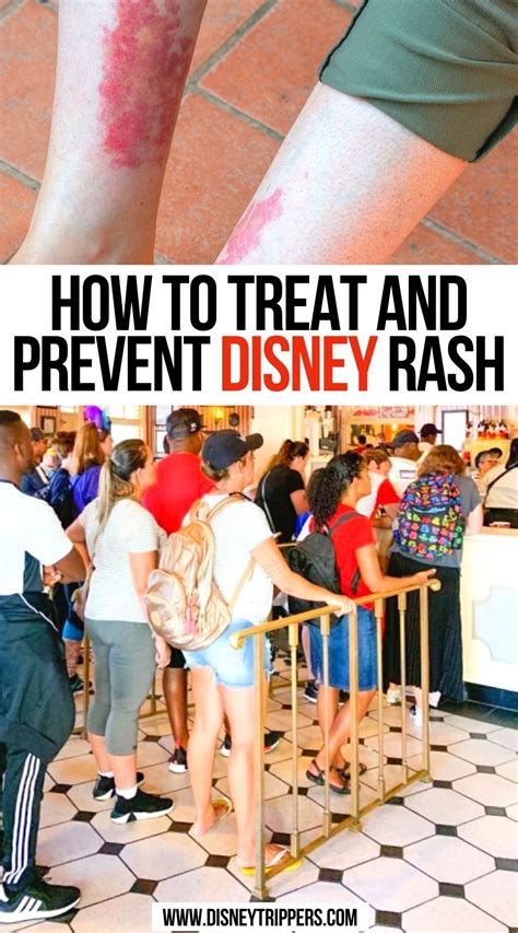 How To Treat And Prevent Disney Rash Disney World Resorts Disney