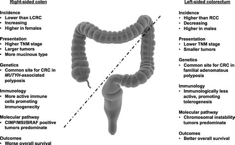 Is Right Sided Colon Cancer Different To Left Sided Colorectal Cancer A Systematic Review