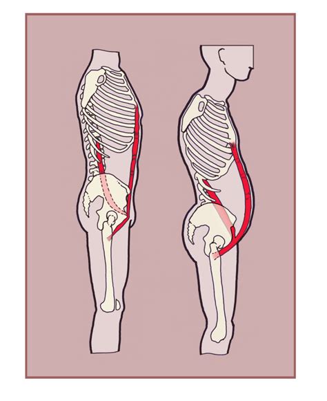 Psoas Major And Rectus Abdominis A Strained Alliance