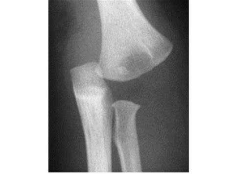 Fracture Separation Of The Distal Humeral Epiphysis Post Orthobullets