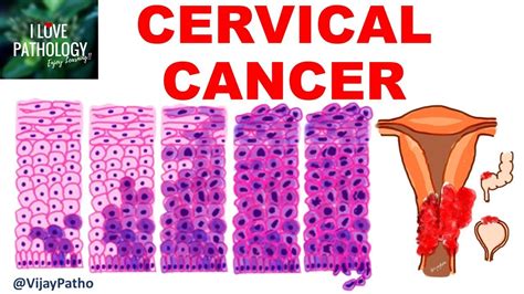 Squamous Intraepithelial Lesion And Cancer Cervix Youtube