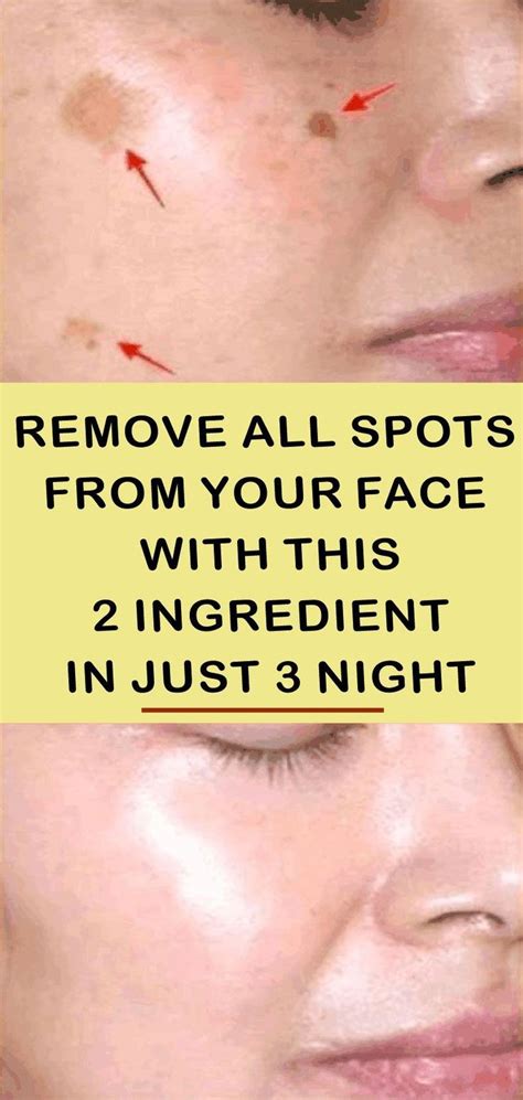 Removes All Spots On Your Face In Just 3 Nights Remove Dark Spots