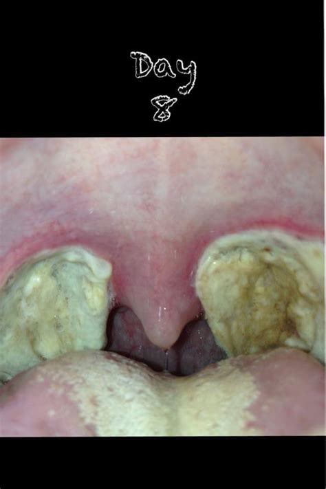 After Tonsillectomy What To Expect Tonsillectomy