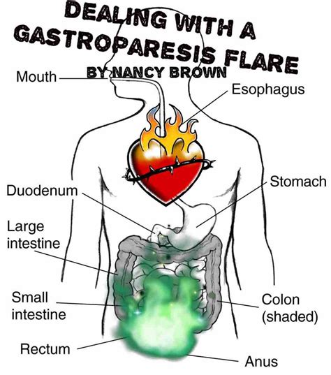 Dealing With A Gastroparesis Flare In 2020 Gastroparesis