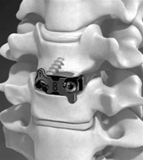 Advances In Spinal Interbody Cages Jain 2016 Orthopaedic Surgery Wiley Online Library