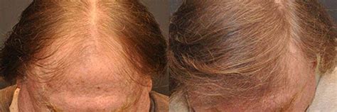 Year Old Caucasian Male Red Fut Hair Transplant Before After Hair