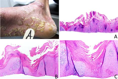 Diffuse Hyperkeratotic Patches And Plaques On The Ankle And Plantar
