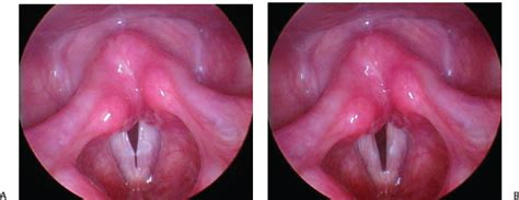 Smoking and alcohol are the major causes and. Abnormalities of the Mucosal Wave | Ento Key