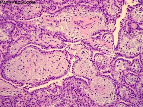 Peritoneal multicystic mesothelioma peritoneal multicystic mesothelioma (pmm) arises almost exclusively from the peritoneum (2,25);. Histopathology images of Mesothelioma, well-differentiated ...