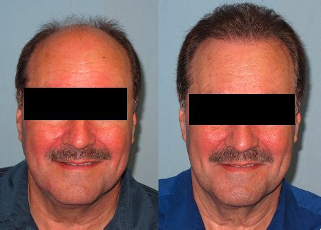 A Guide To Hair Transplantation After 50 Years Of Age Cyber Hairsure