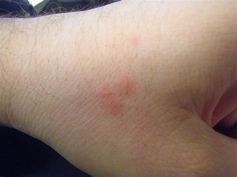 Bed Bug Bites Effects Moreoo