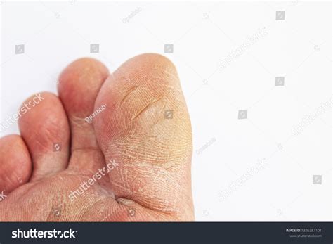 Cracked Skin Toe Isolated Stock Photo 1326387101 Shutterstock