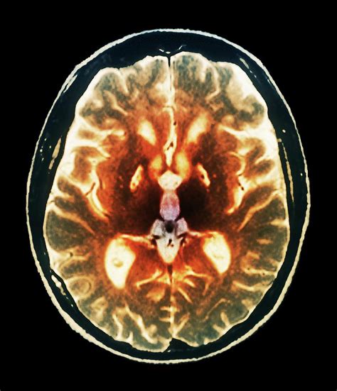 Anoxia Brain Damage Photograph By Zephyrscience Photo Library Fine