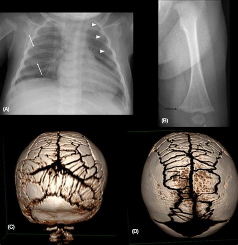 Wormian Bones Thinking Beyond Osteogenesis Imperfecta Archives Of