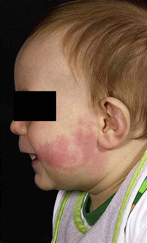 Skin Signs Of Systemic Disease Paediatrics And Child Health