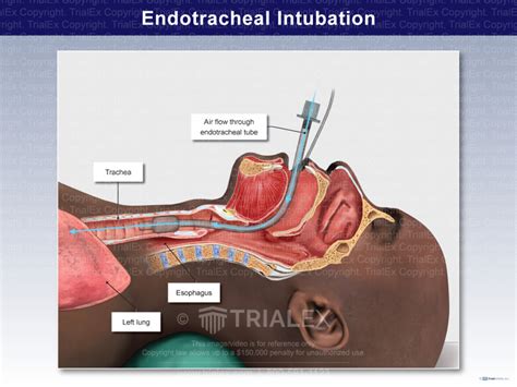 Endotracheal Intubation Trial Exhibits Inc