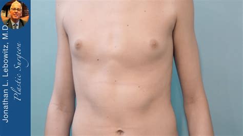 14 Y O Puberty Gynecomastia Surgery AWAKEAt The Long Island