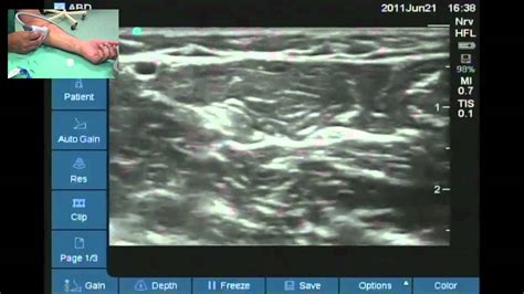 Ultrasound Variation In Anatomy Of Ulnar Nerve Left Side Youtube