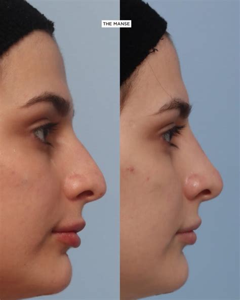 Nose Filler Non Surgical Rhinoplasty At Our Expert Sydney Clinic