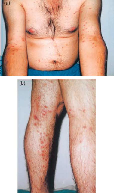 Follicular Erythematous Patches Of Papules And Pustules A On The Download Scientific Diagram